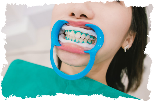 sbiancamento dentale